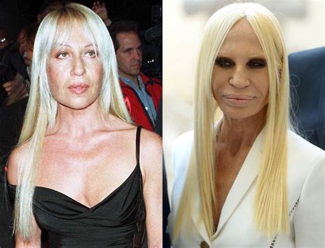 domatella versace|Donatella Versace before and after surgery.